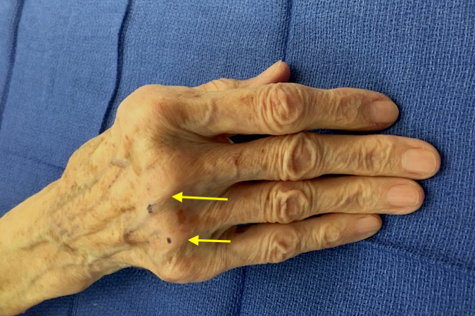 Note chronic long and ring radial sagittal band ruptures with ulnarly subluxed extensor tendons (arrows).
