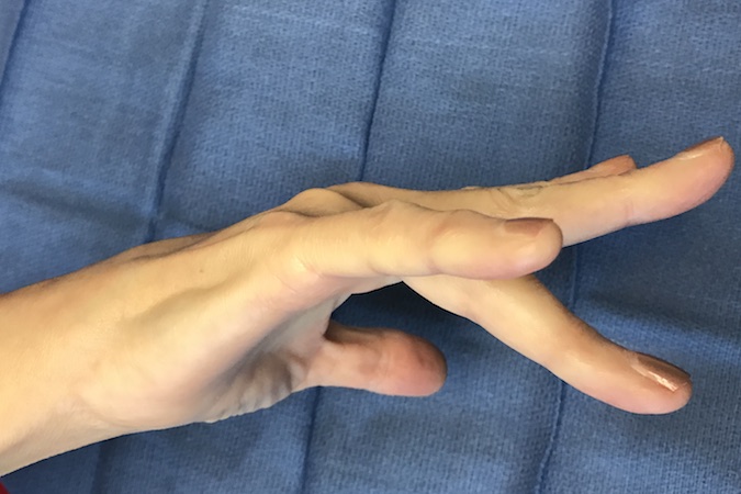 Extensor Tendon Subluxation Right Ring Finger