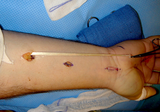Three months after stage I, Stage II of FDP reconstruction is done. Here the palmaris longs (PL) graft is being harvested through three small incisions. Tendon stripper could also be used