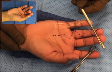 Patient presents with a eight month old tag football injury with incisions for reconstruction outlined.
