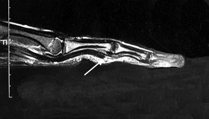 MRI of ringer finger jersey finger injury with distal end of FDP tendon (arrow) caught at the level of  PIP vincula and chiasma of Camper.