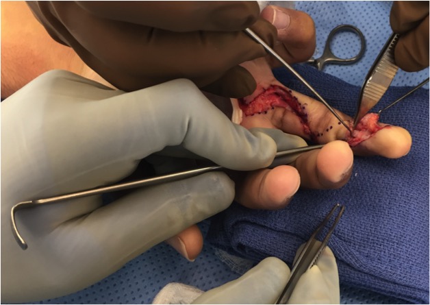 Distal stump of FDP being dissected free at DIP joint level.