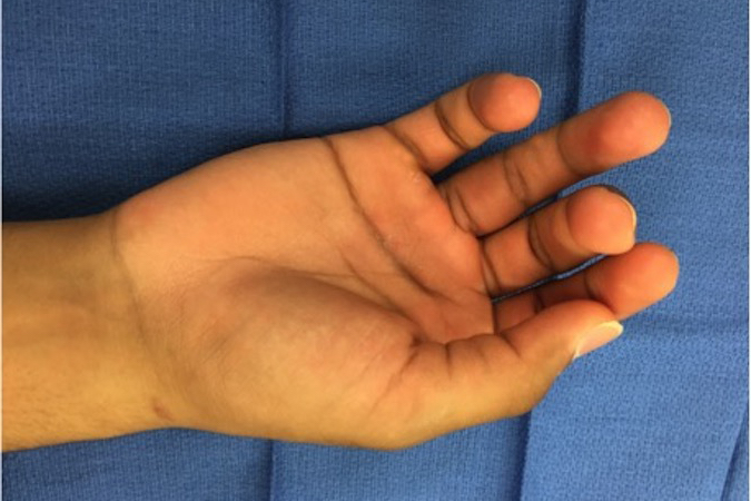 Patient presents with a eight month old tag football injury.  Patient complaining of weak grip and decreased ring finger flexion.