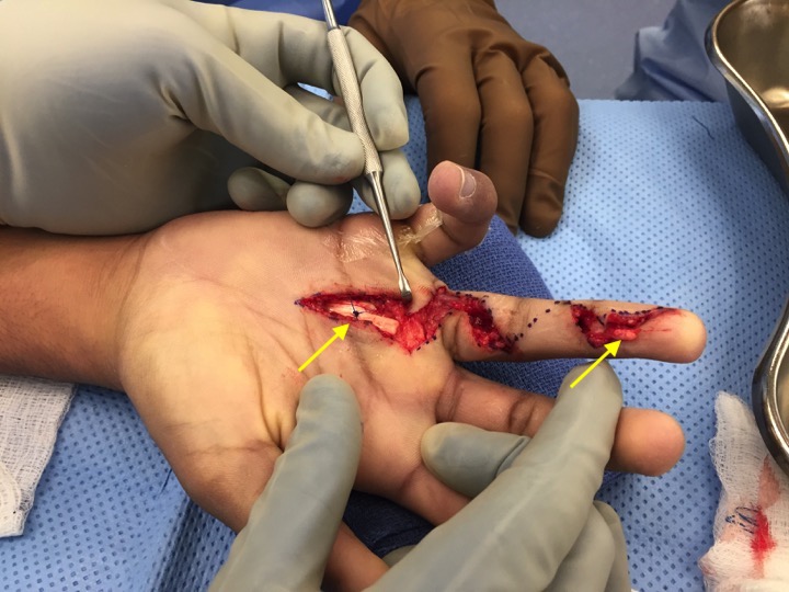 Proximal arrow FDP attached to edge of A-1 pulley with a tagging 2-0 proline suture and distal FDP stump ready to suture to Hunter rod (distal arrow).