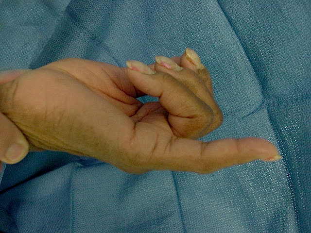FDS and FDP not functioning in fifth finger. FDP cut in ring and long with both tendons intact in index finger.