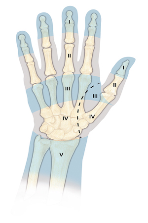 Flexor Tendon Zones of injury for fingers, thumb, hand and wrist.  The most difficult repairs are those done in Zone II where the fibro osseous tunnel of the flexor tendon sheath is narrow and tight.