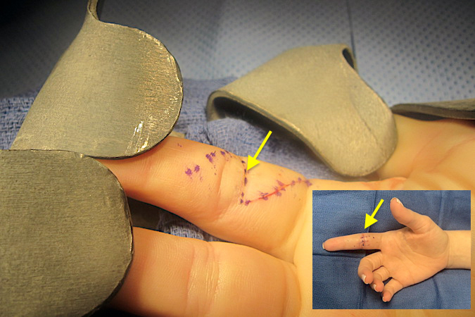 Right index FDP and FDS lacerations (arrow) with incision outlined for repair.