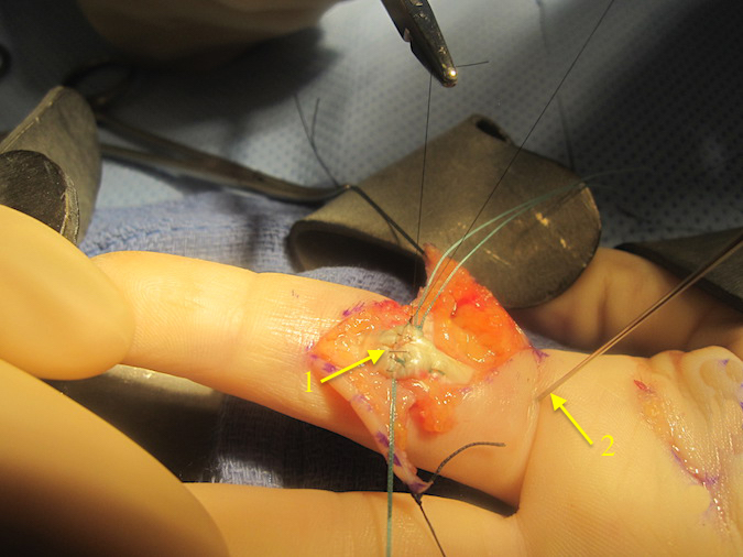 Core suture tied but not cut completely. Volar edge suture (6O nylon) being placed (1).  Needle (2) blocking FDP retraction still in place.