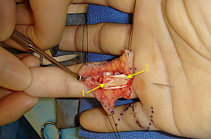 Ringer finger FDS & FDP laceration.  FDP (1) has been retrieved and brought through FDS slips forming the chiasma of Camper (2).