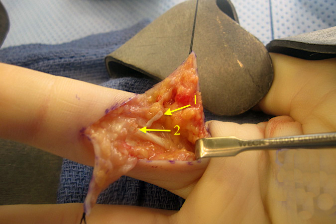 Right index FDP and FDS lacerations with incision open. A slip of cruciate pulley is seen (1) and partial laceration of FDS noted (2).