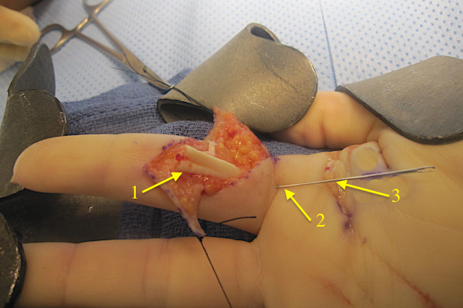 Right index FDP (1) has been retrieved and needle is preventing FDP retraction (2).  Palm incision (3) was used to assist FPD retrieval.