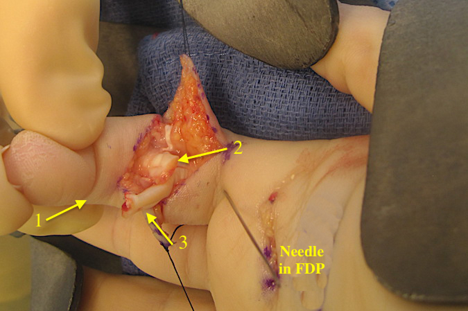 DIP passively flexed to express the distal FDP (2) into the surgical site.  Proximal FDP (3).