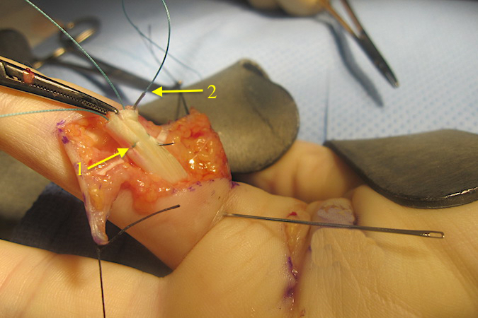 First core suture with a modified Kessler suture is in place (1).  Second core suture (2) being placed in the radial aspect of the FDP tendon.  Second needle placed carefully to avoid damaging the first suture.