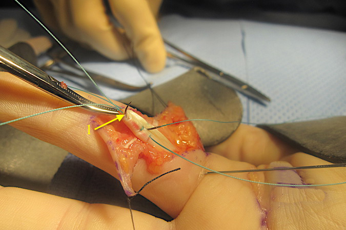  Final pass of the needle for the second core suture (1) being placed in the proximal FDP.