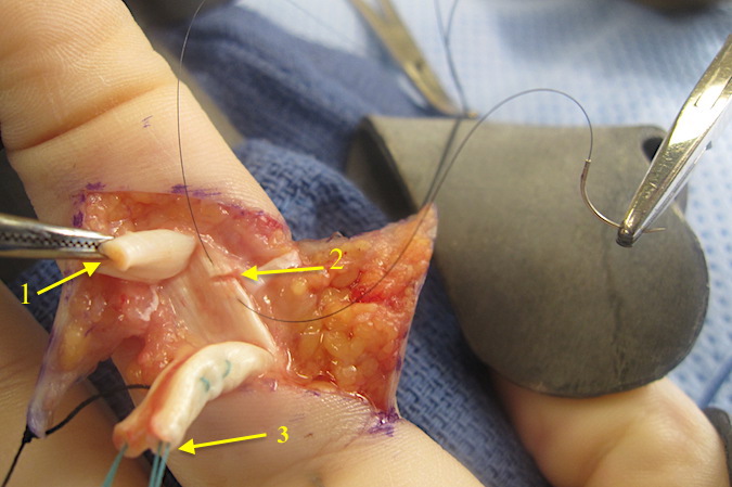 Tiny clamp (1) gently holding distal FDP so tendon will not have to be grasped repeatedly.  Small FDS laceration being tidied up with 6O nylon suture (2).  Modified Kessler core sutures in proximal FDP (3).