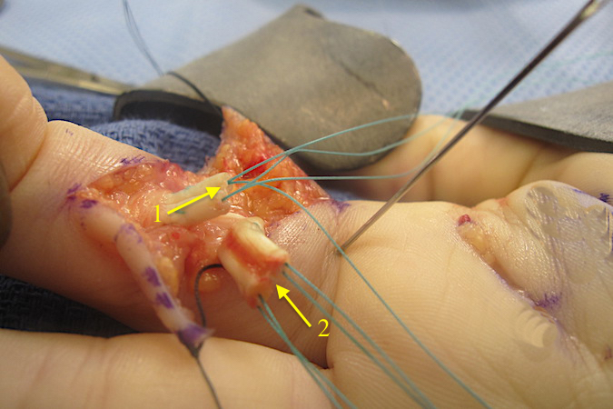 Core sutures in distal FDP (1) and proximal FDP (2).