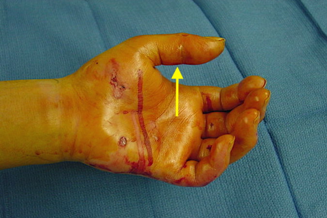 Flexor Tendon Sheath Infection thumb with uniform swelling of the entire thumb flexor tendon sheath and early thenar swelling.