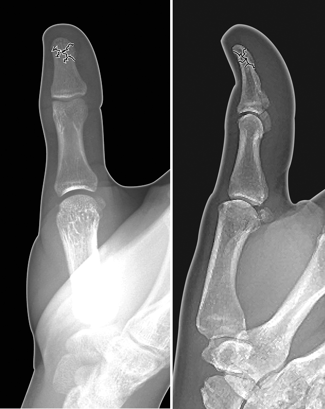 Thumb distal phalanx non-displaced tuft fracture