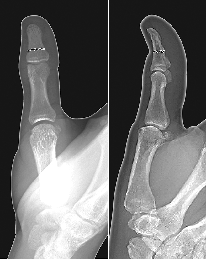 Thumb distal phalanx non-displaced shaft fracture