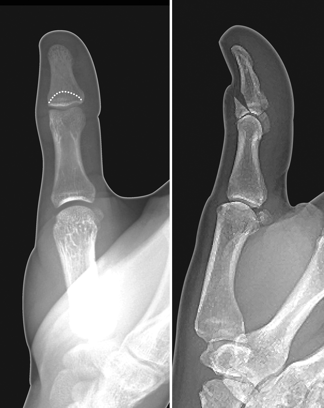 Thumb distal phalanx displaced intra-articular EPL avulsion fracture