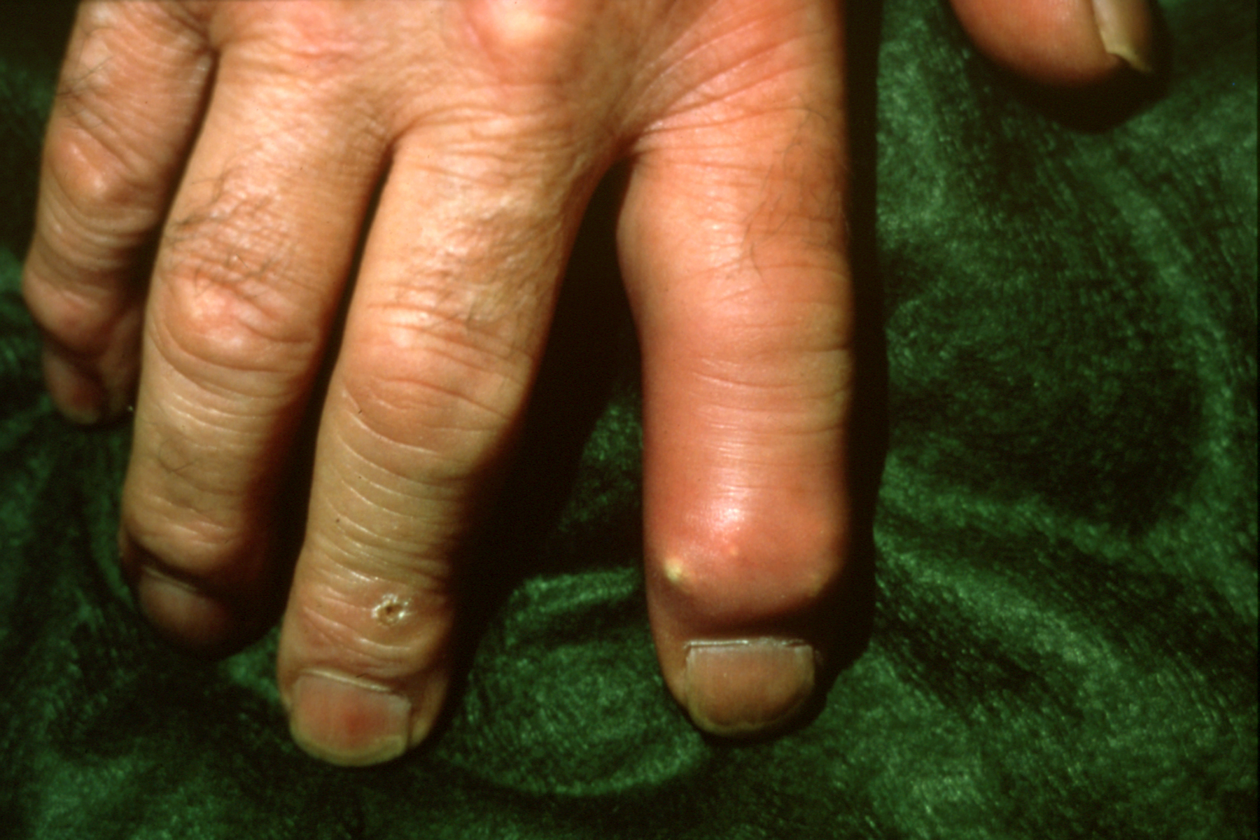 Gout at DIP presenting like a paronychia of the index finger.