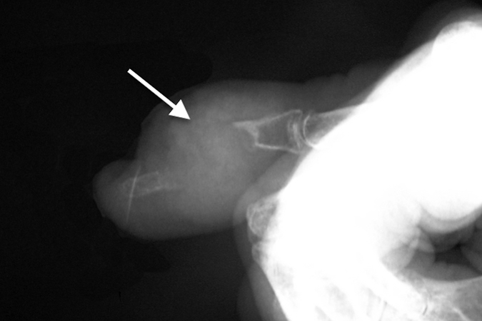 Severe tophaceous gout with DIP joint destruction and phalangeal bone loss (arrow)