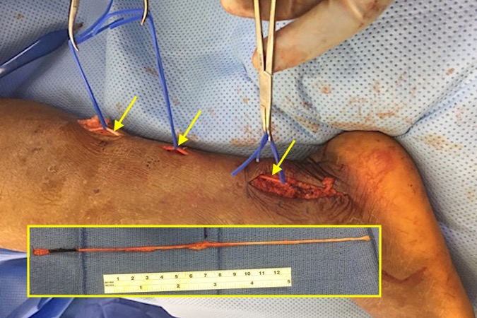 Sural nerve grafts (arrows) taken from the opposite leg.