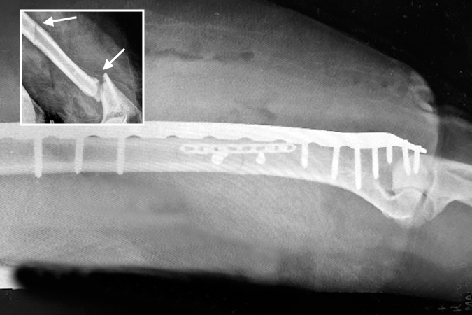 Open segmental humerus fracture (arrows) with radial nerve laceration in a patient with  multiple injuries.