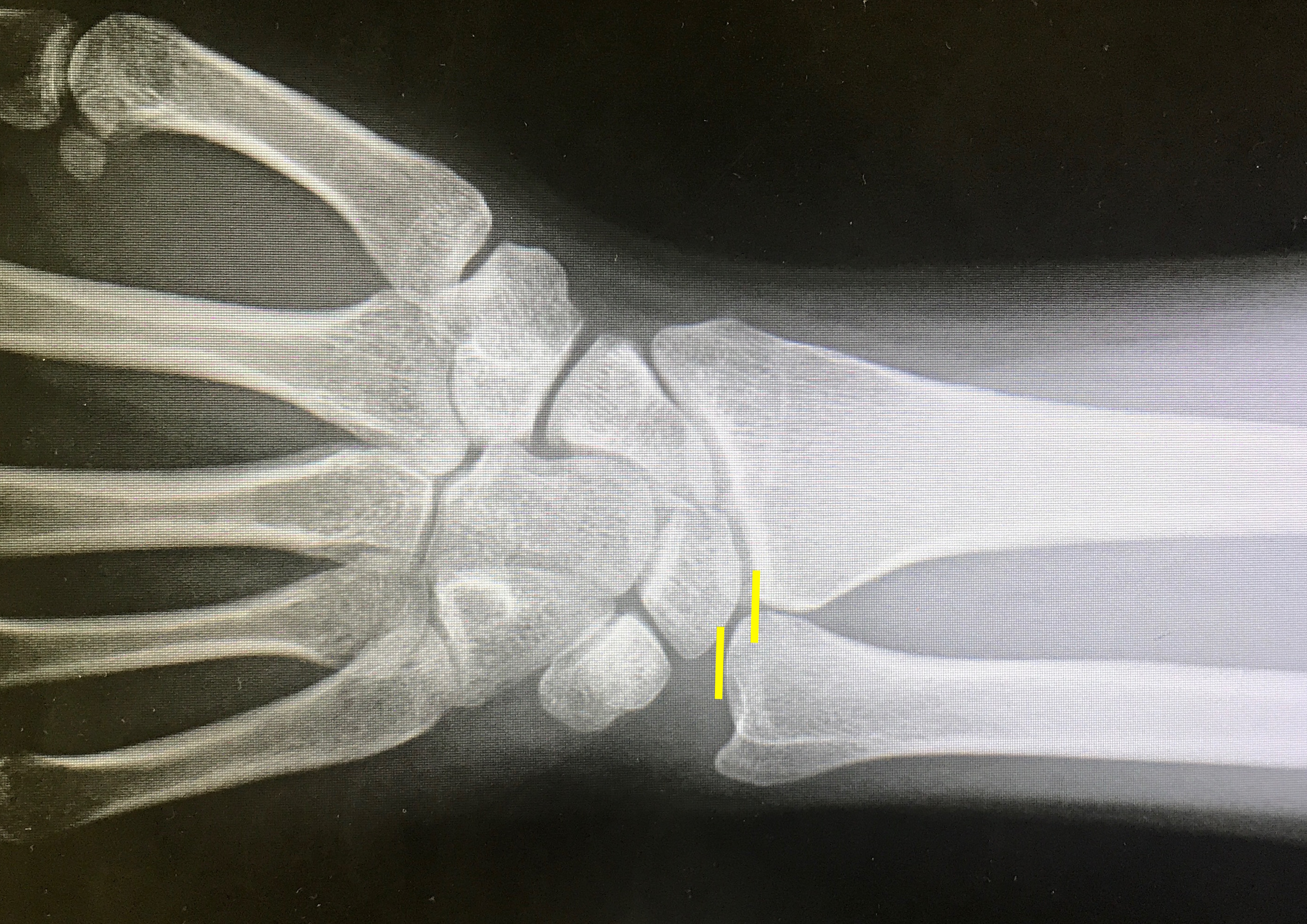 Positive ulnar variance is often associated with L-T tears.