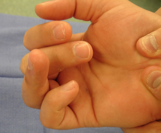Note lack of DIP joint flexion when tenodesis affect is used to flex the football player's fingers.