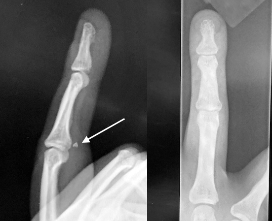 X-ray of ringer finger jersey finger injury with avulsion fracture fragment (arrow) caught at the level of  PIP vincula and chiasma of Camper.