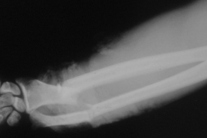 AP X-ray of right open distal -third transverse radius and ulna fractures 