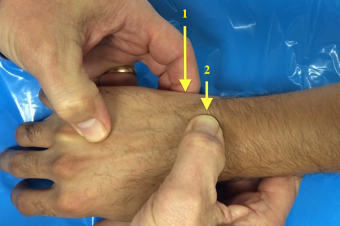 The L-T ballotment test is used to assess tenderness and instability. The examiner's left index is applying upward pressure on the pisiform (1) to indirectly put pressure on the triquetrum while the left thumb pushes the lunate volarly.
