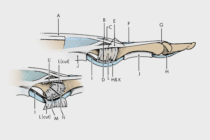 A. Extensor tendon; B. Central slip; C. Oblique fibers of dorsal aponeurosis; D. Lateral slip; E. Conjoined lateral band; F. Triangular ligament; G. Terminal extensor tendon; H. Flexor digitorum profundus; I. Volar plate; J. A-2 & A-4 pulleys; K. Flexor digitorum superficialis; L. Transverse retinaculum; M. Accessory collateral ligament; N. Proper collateral ligament.  During a flexor tendon avulsion injury the FDP (H) is torn from its insertion into the distal phalanx.