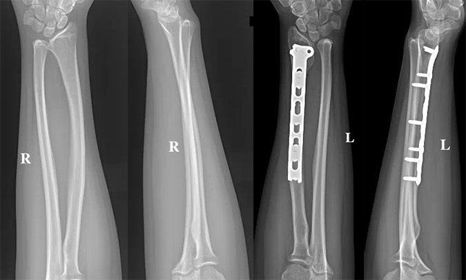 Madelung’s deformity of left wrist post osteoplasty three year follow up comparison views.