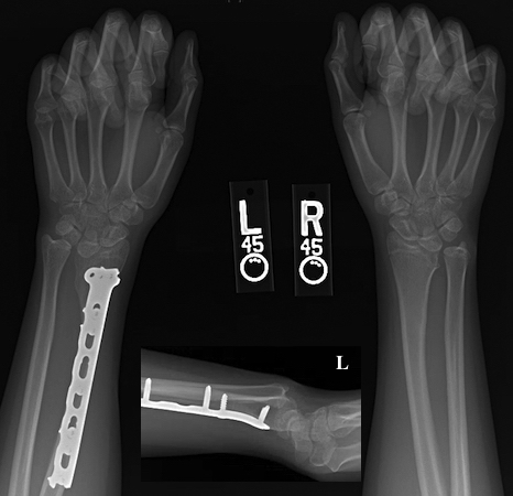 Madelung’s deformity of left wrist post osteoplasty three year follow up