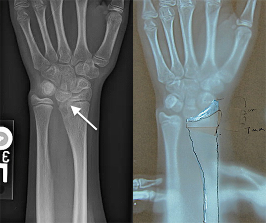 Madelung’s deformity of left wrist in 11 year old female.  Note epiphysiodesis  at arrow.  Tracing paper used to define wedge size and location.