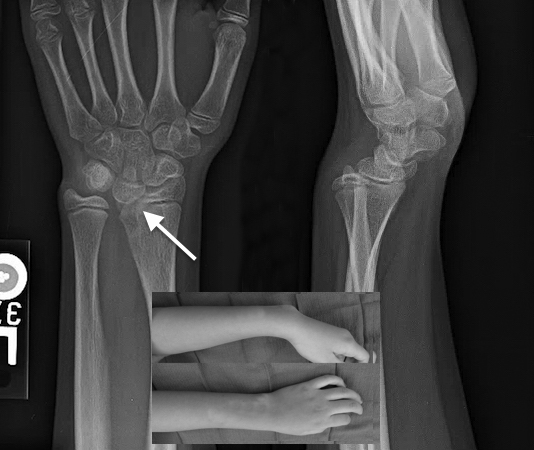 Madelung’s deformity of left wrist in 11 year old female.  Note epiphysiodesis  at arrow.Used Mad 2
