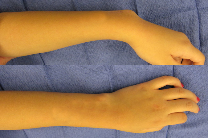 Madelung’s deformity of left wrist in 11 year old female