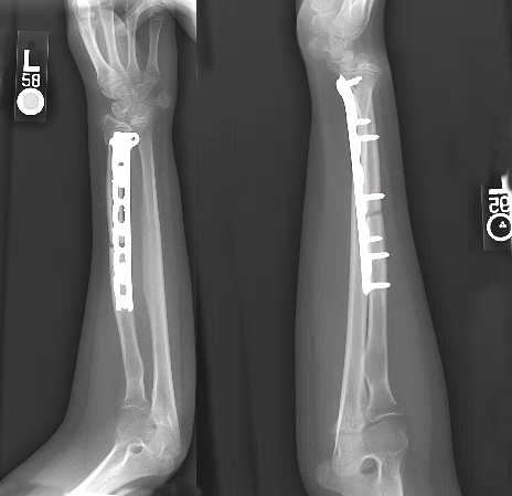 Madelung’s deformity of left wrist post osteoplasty and internal fixation.