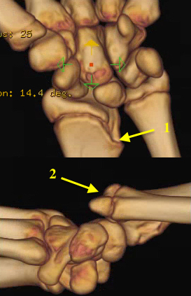 3D r reconstruction from Distal Radius CT: i - epiphysiodesis; 2 - Dorsal displaced  distal ulna