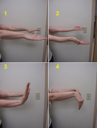 Female teenager 12 years after bilateral radial osteoplasties: 1- active pronation; 2 - active supination; 3 - active dorsiflexion; 4 - active palmar flexion.