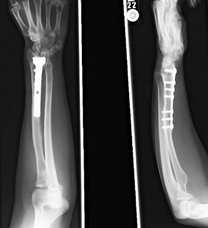 Left osteoplasties initially stabilized with K-wires, closing wedge bone used to graft opening distal wedge, and final stabilization done with a extra long T-plate.
