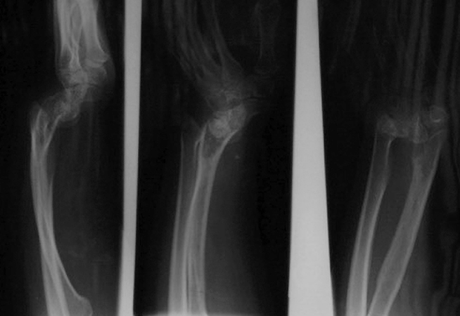 Teenager female with bilateral Madelung's Deformities. Note X-rays of left wrist and forearm.