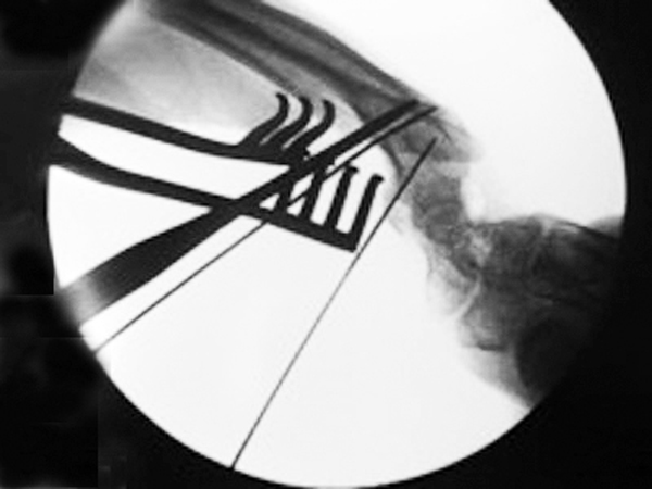 Osteoplasty and joint location is outlined by K-wires and verified by fluoroscopy.