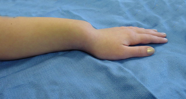 Madelung’s deformity of left wrist in 14 year old female