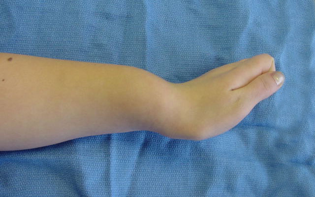 Madelung’s deformity of left wrist in 14 year old female lateral view in max dorsiflexion