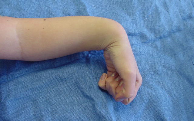 Madelung’s deformity of left wrist in 14 year old female lateral view in max palmar flexion