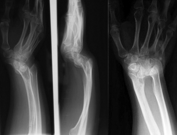 Teenager female with bilateral painful Madelung's Deformities. Note X-rays of right wrist and forearm