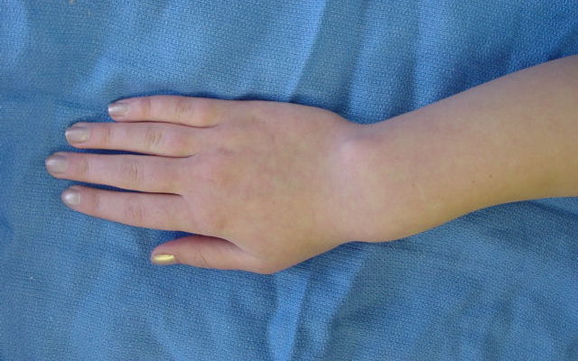 Madelung’s deformity of right wrist in 14 year old female